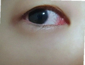 요즘 눈 상태