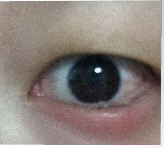 요즘 눈 상태