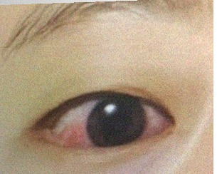 요즘 눈 상태