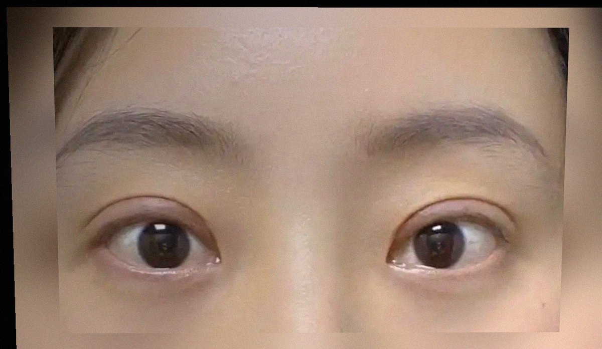 요즘 눈 상태