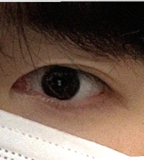 요즘 눈 상태
