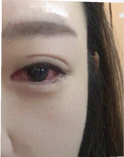 요즘 눈 상태