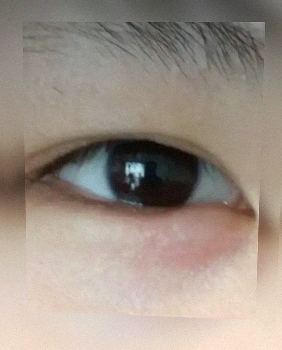 요즘 눈 상태