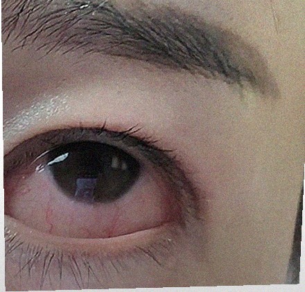 요즘 눈 상태