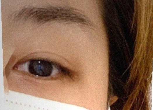 요즘 눈 상태