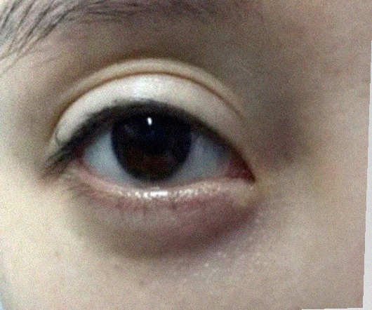 요즘 눈 상태